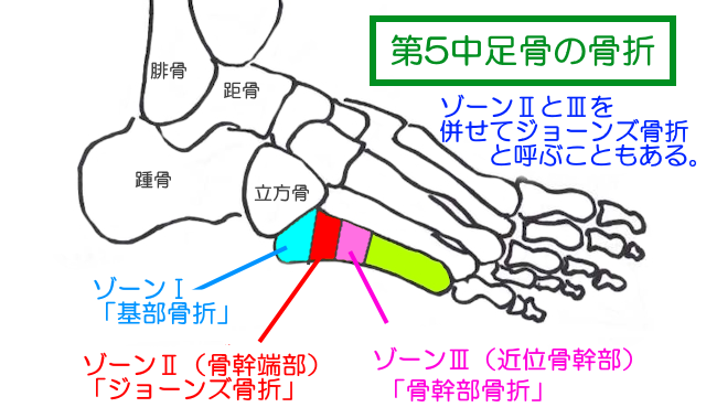 第5中足骨の近位部での骨折は部位によって予後が違うので注意が必要