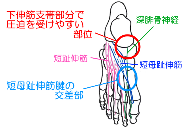 足部を走行する深腓骨神経は下伸筋支帯部分と短母趾伸筋腱の交差部分で圧迫を受けやすい