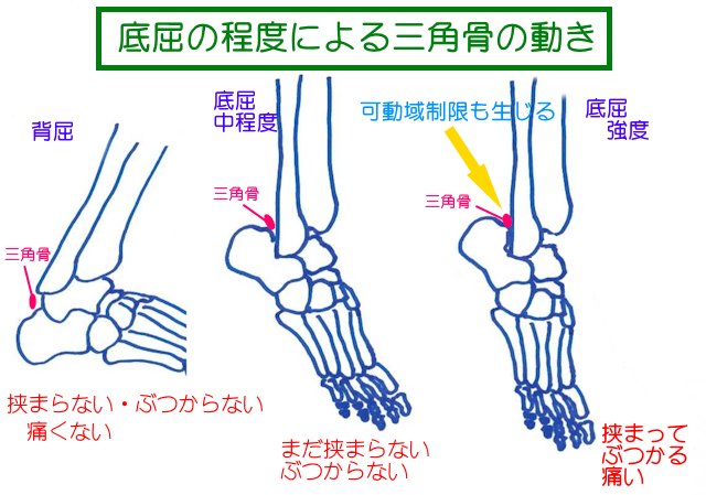 三角骨障害では、底屈の程度によって疼痛がでないことがある。一般的に底屈度が強ければ強いほどインピンジメントを引き起こし疼痛が発生する