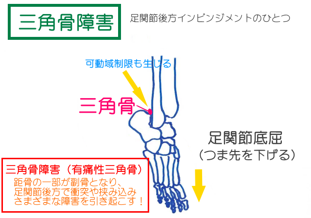 三角骨障害（有痛性さんっかうこつ）は距骨の一部が三角骨となり、足関節後方で衝突や挟み込み、ロッキングなどさまざまな障害を引きおこす。