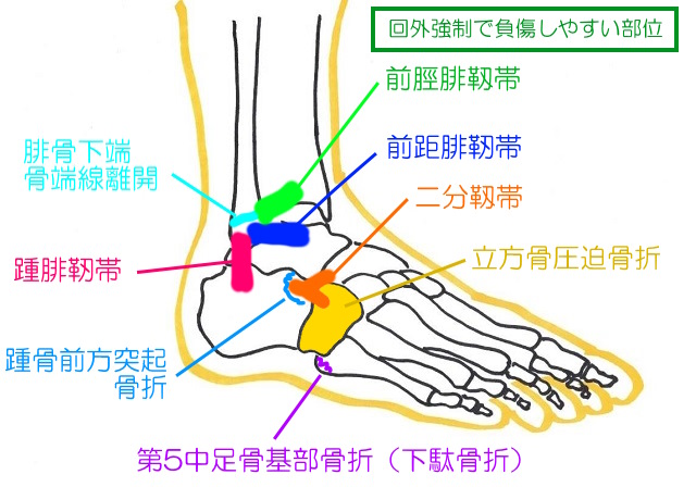 足首外側で負傷しやすい場所。前距腓靭帯・踵腓靭帯・二分靱帯・第5中足骨基部・踵骨前方突起・外果剥離骨折・前脛腓靱帯・立方骨圧迫骨折など