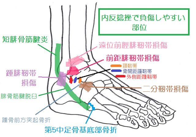 足部を内反矯正して受傷する靱帯。おもに外側を支持する靱帯で、前距腓靭帯や踵腓靭帯が多いが、そのほかの部分の受傷も見逃せない