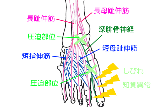足部深腓骨神経麻痺の起きる原因は外部からの圧迫