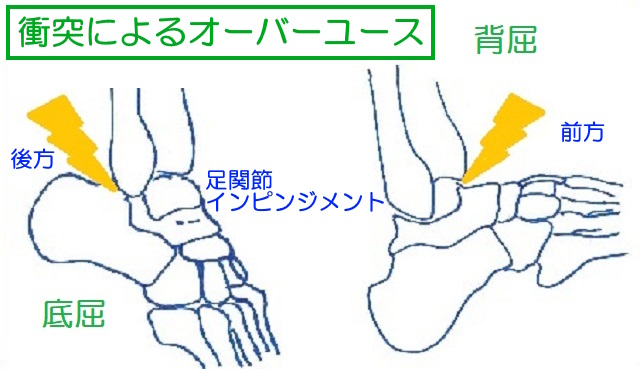 足関節の底屈背屈で骨がぶつかるのはインピンジメントと呼ばれスポーツ障害のひとつ