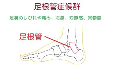 足根管症候群。足の裏側の痺れや痛み。チネル徴候に要注意！