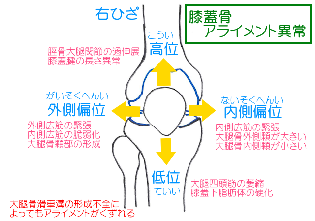 さまざまな理由で起きる膝蓋骨アライメント異常