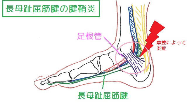 足根管を通る長母趾屈筋腱が摩擦を起こして炎症を生じる長母趾屈筋腱腱鞘炎
