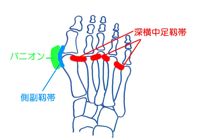 母趾中層趾節関節側面の痛みは外反母趾バニオン、側副靱帯損傷、志納中足靱帯損傷などが考えられる