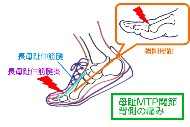 母趾MTP背側の痛みには強剛母趾や長母趾伸筋腱の炎症が考えられる