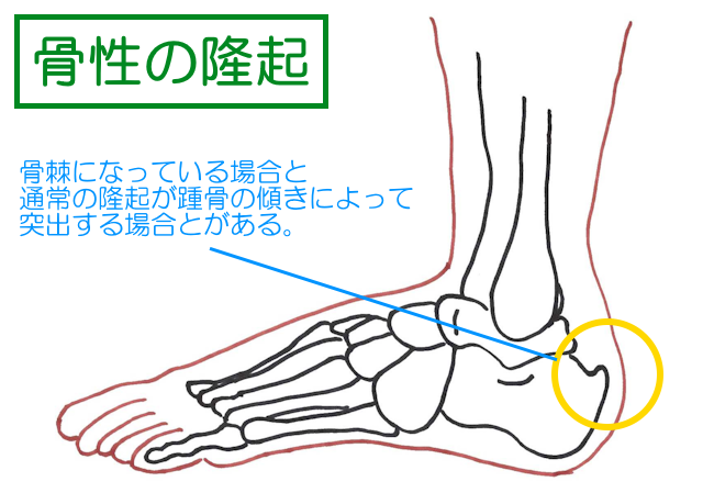 骨製の隆起は、骨棘になっている場合と通常の隆起が踵骨が傾くことで後方に突出してします場合がある。