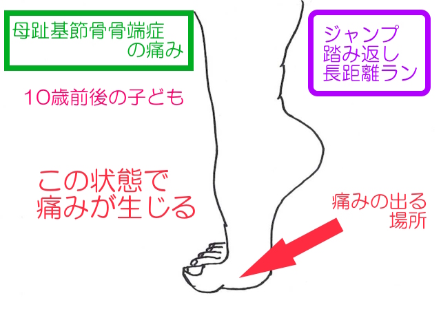 母趾基節骨骨端症は、つま先立ちなどで母趾背屈状態で地面に足を着いたときに痛みが生じる