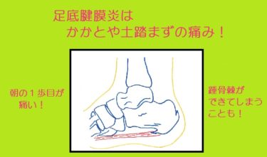「足底腱膜炎」足の裏かかとや土踏まずの痛み。踵骨棘ができるしくみ