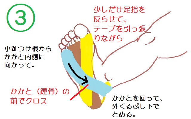 足底腱膜炎テープ3本目。小趾側から斜めにかかと内側に向かって貼る。かかとの後ろを回って外くるぶし下で止める