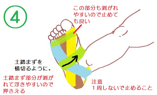 足底腱膜炎テープ4本目。土踏まずが浮きやすいので横断するように留める。足の甲で1周しないように注意。足趾側も剥がれやすければ止めても良い