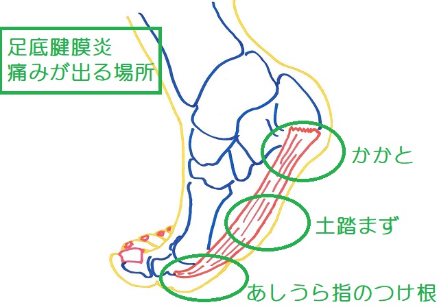 足底腱膜炎ではかかと ・土踏まず・足指のつけ根部分に痛みが生じることが多い