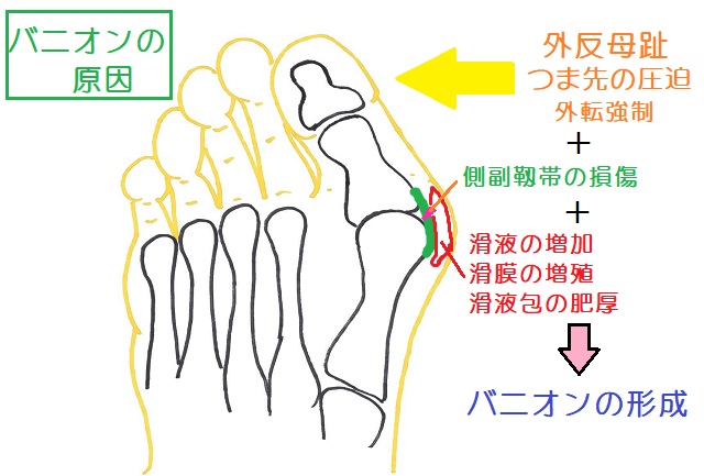 母趾の外転強制や圧迫、外反母趾によって母愛MTP関節内側の靱帯に損傷を生じ、滑液包や滑膜の炎症を生じる。その結果バニオンが形成される