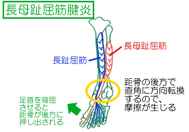 足首を背屈すると距骨が後方に押し出されるので©棒母趾屈筋と距骨後突起が摩擦を起こしやすい