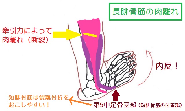 内反強制が強く働くと長腓骨筋の筋腹が肉離れを生じる。短腓骨筋は第5中足骨基部で裂離骨折を起こしやすい