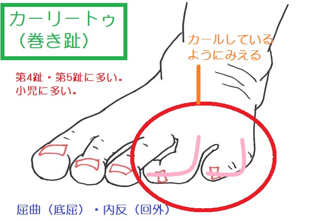 カーリートゥは巻き趾ともいわれ、小児に多く、第4趾・第5趾が底屈＋内反する
