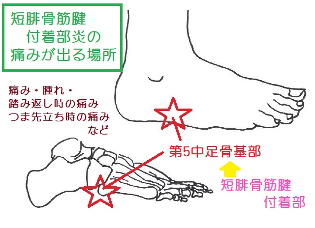 短腓骨筋腱付着部炎では、足部外側のかかと寄りにある突起部に痛みが出る