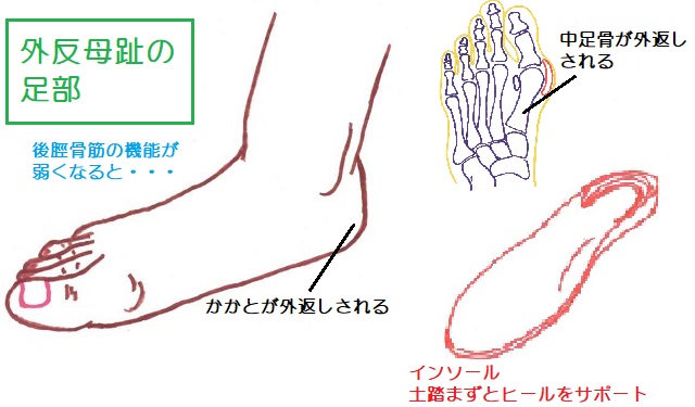 外反母趾では踵骨が外返しされて、第一中足骨も外返し。ヒールと土踏まずをサポートするインソールを使用する