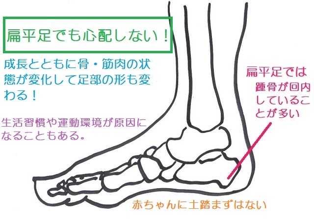 扁平足は足の特徴を示しているだけ