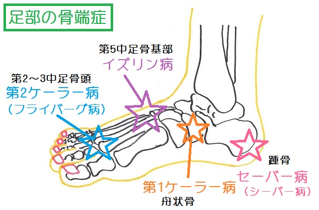 足部の骨端症