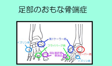 子ども特有の足の痛み「足部の骨端症」の場所と種類。