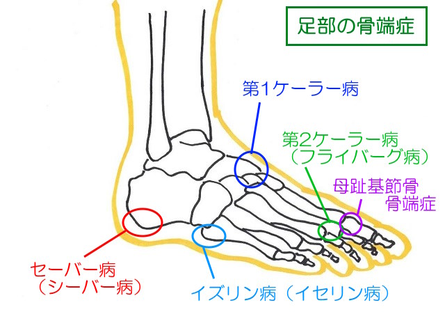 足部の骨端症は第1ケーラー病、第2ケーラー病（フライバーグ病）、セーバー病（シーバー病）、イズリン病（イセリン病）、母趾基節骨骨端症などがある
