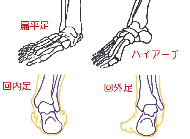 足部の形状も踵部の負荷に大きな影響を与える