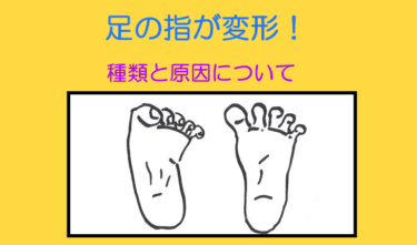 足の指（足趾）と変形。種類と原因は？