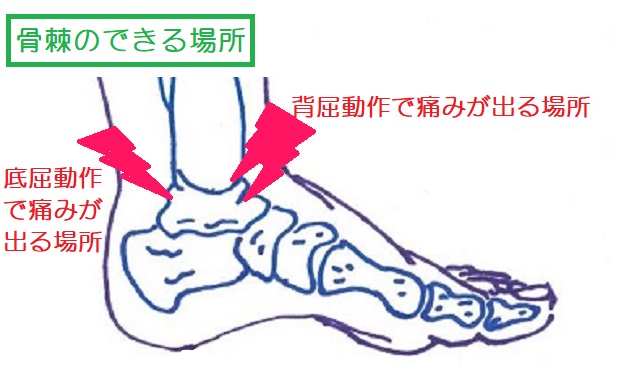 足首で骨どうしの衝突によって骨棘ができる場所