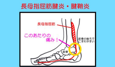 『長母趾屈筋腱炎・腱鞘炎』は足首の後ろの痛みやひっかかり感。