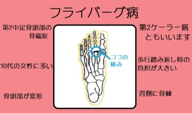 フライバーグ病（第2ケーラー病）は足指つけ根の痛みがでる骨端症