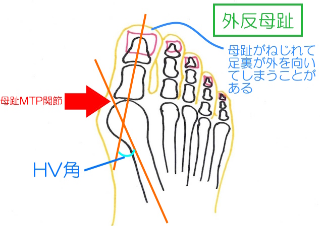 母趾が外側を向き、中足骨が内側を向くのが外反母趾。両方の長軸が交わる角度がHV角