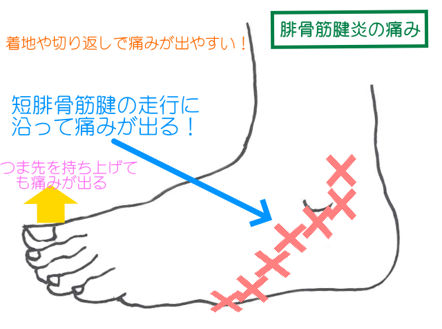 腓骨筋腱炎では、つま先を持ち上げたり、切り返し、着地のときに外くるぶし後方から下部に痛みが生じる