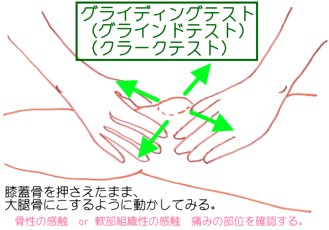 グライディングテストでは膝蓋骨を上から押さえつけながら、関節面にこするように膝蓋骨を動かす。骨性または、軟部組織性の感触を確かめたり、疼痛の部位を確認する。