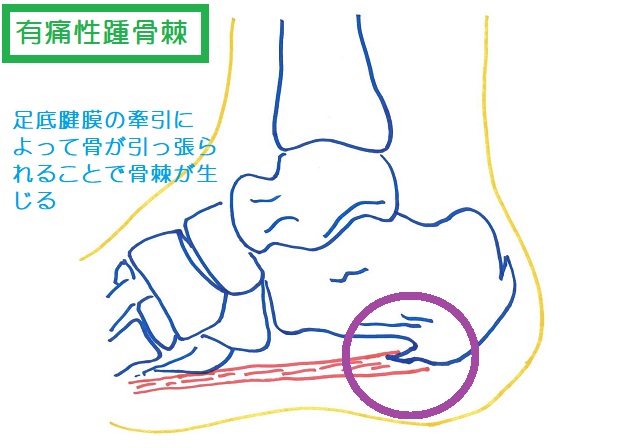 足底腱膜の牽引によって骨が引っ張られることで骨棘を生じる