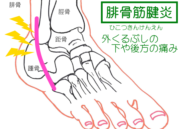 腓骨筋腱炎は外果後方&下部の痛み