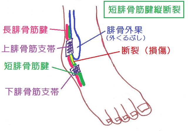 短腓骨筋腱は長腓骨筋腱と外果に挟まれて損傷する