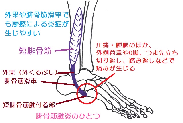 短腓骨筋腱は外果や腓骨筋滑車でも摩擦を起こしやすく、付着部炎とともに腓骨筋腱炎ともいわれる