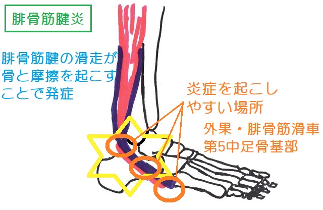 腓骨筋腱炎は外果・腓骨筋滑車、第5中足骨基部で起きやすい。腱の滑走が摩擦を引き起こすことで発症