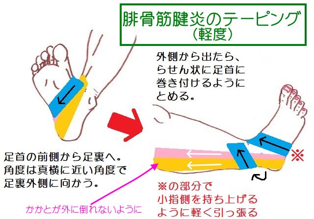 腓骨筋腱炎のテーピングは、基本的に外側を持ち上げるように貼る