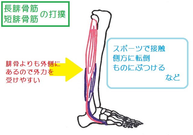 長腓骨筋と短腓骨筋は腓骨よりも外側にあるので、スポーツや日常生活で打撲しやすい