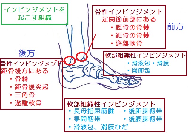 足関節のインピンジメントの種類
