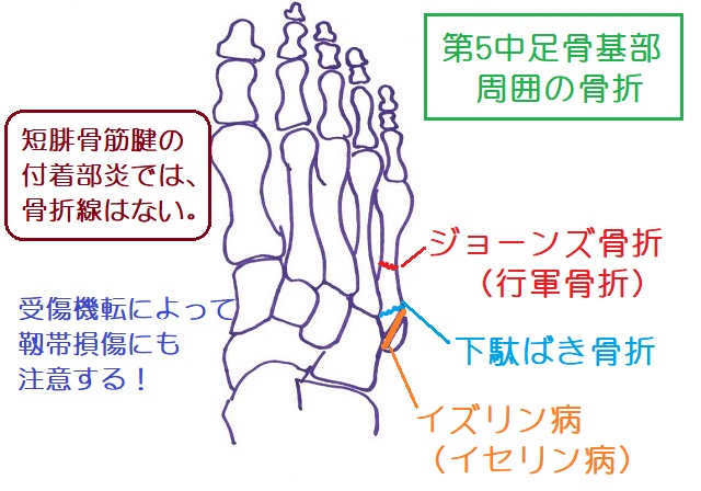 第5中足骨基部周辺の鑑別。イズリン病は縦。下駄ばき骨折は横。ジョーンズ骨折は骨幹部に骨折線が見える