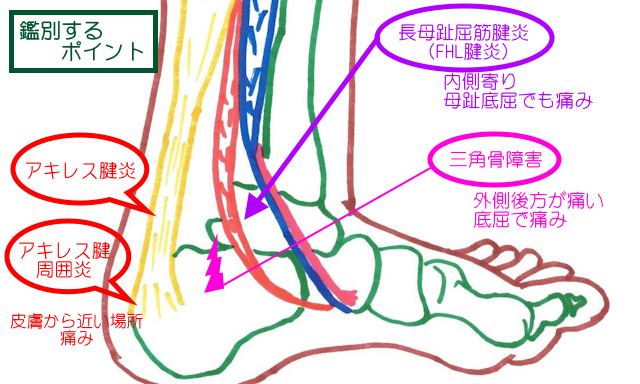 ケーラー脂肪体炎・三角骨障害・長母指屈筋腱炎の鑑別ポイント