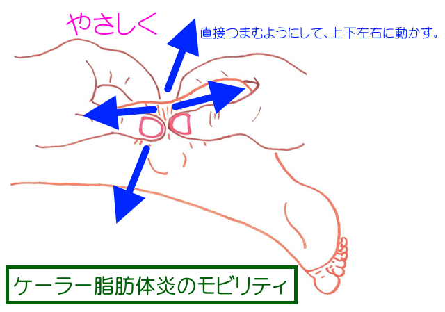 ケーラー脂肪体炎（癒着）のモビリティ。直接つまんで優しくいろいろな方向に動かしてみる。