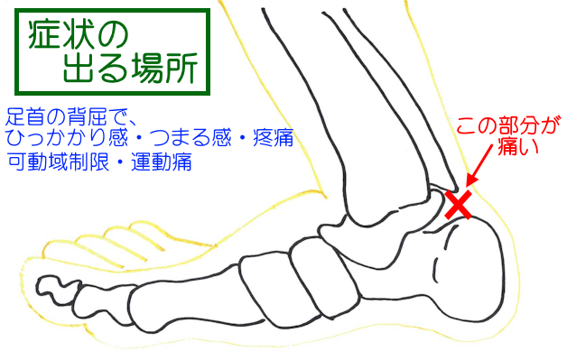 ケーラー脂肪体炎の症状が出る場所。 おもに足関節背屈運動時に、つまり感や背屈制限として現れる