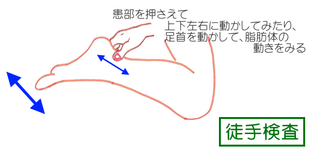 徒手検査では、患部をつまんで前上下左右に動かして内部の動きをみる。 つまんで足関節を底背屈させてもよい